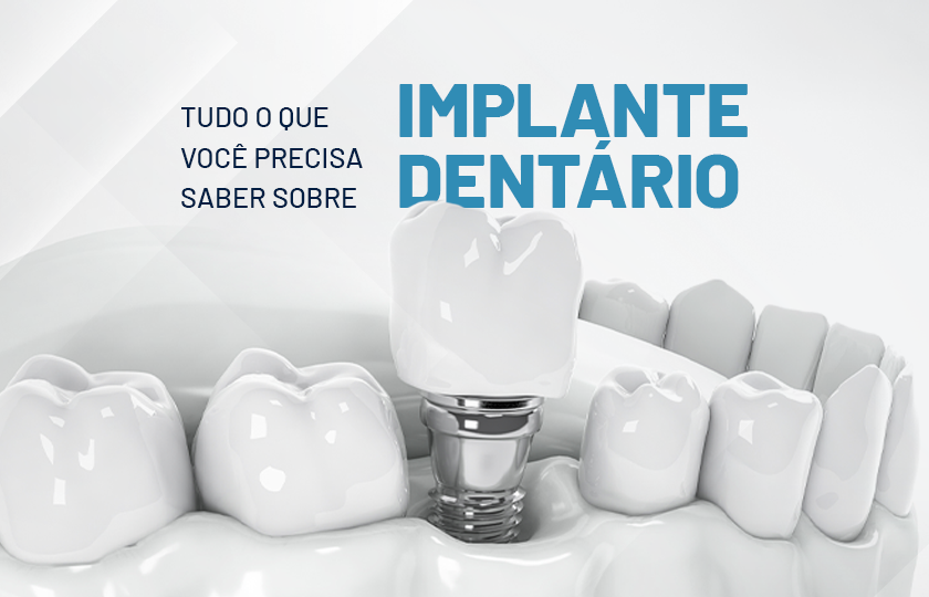 Implantes dentários